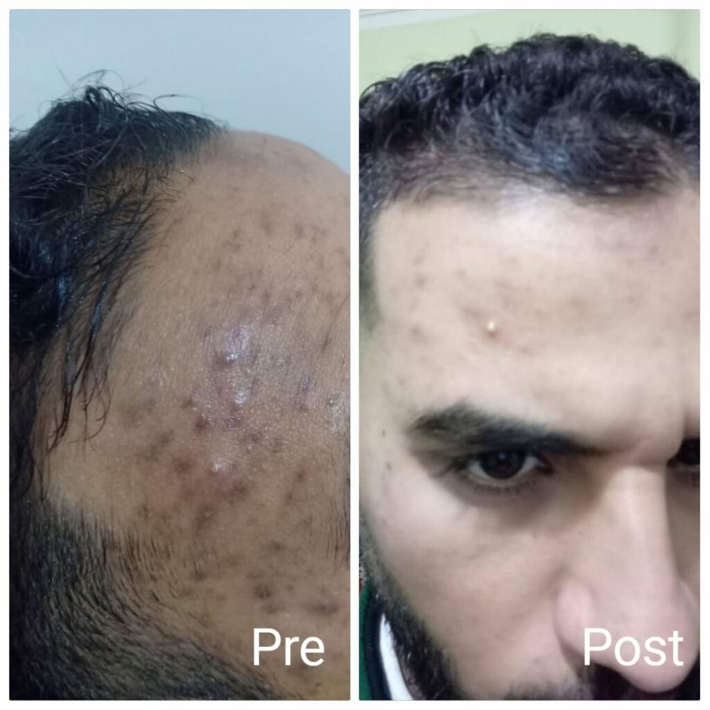 Improved skin appearance after one fractional laser session